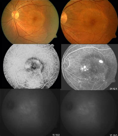 Chronic Csc Unresponsive To Intravitreal Bevacizumab Fa Showed