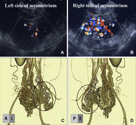 Color Doppler Ultrasonography And D Ct Angiography After Tae A