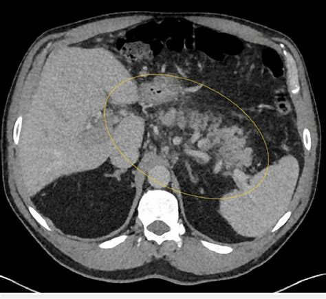 Computerized Tomography Of The Abdomen And Pelvis With Contrast Shows