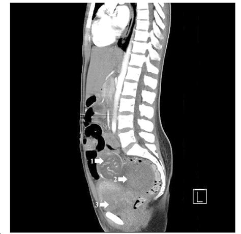 Computed Tomography Angiogram Of Abdomen And Pelvis 1 Intra Abdominal