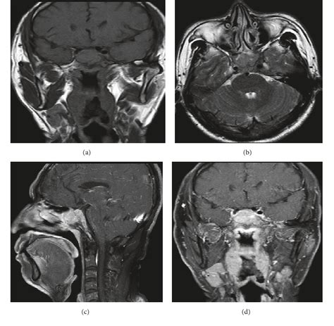 Figure 2 From Primary Sphenoidal Sinus Lymphoma With Initial Presentation As Unilateral Abducens