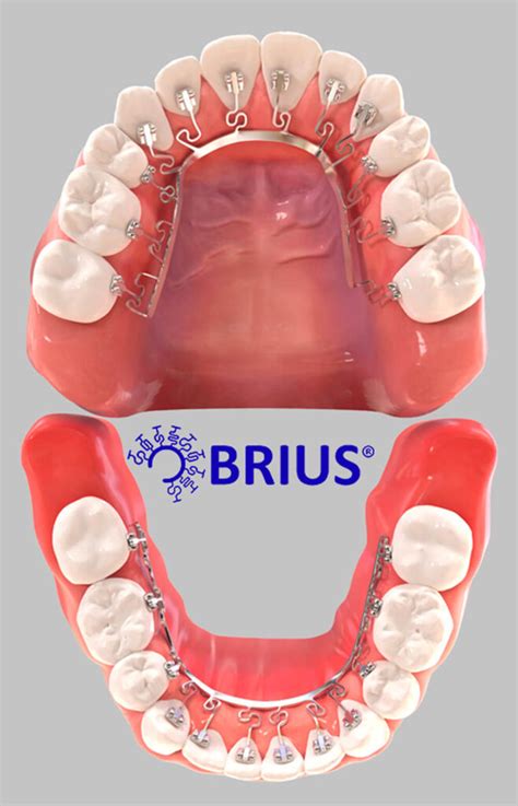 BRIUS Truly Invisible Braces For All Ages Matsumoto Orthodontics