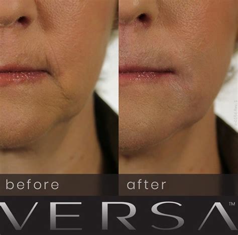 Revanesse Versa Dermal Filler Before After Photos Rancho Mirage Palm