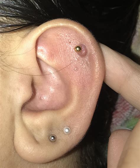 Piercing Irritation Bump Won’t Go Away No Matter What I Do It’s Been Months R Legitpiercing