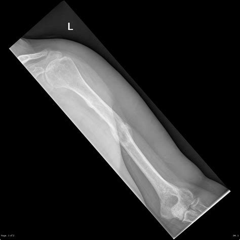 Humeral Fracture Spiral Wedge Midshaft Image