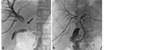 A The Second Percutaneous Transhepatic Cholangiography Shows A Main