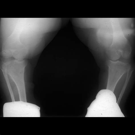 Preschooler With Short Stature And Genu Varum Pediatric Radiology Case Pediatric Imaging