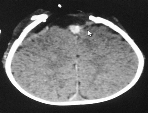 Postoperative Scan Showing Residual Tumor That Has Been Attached To