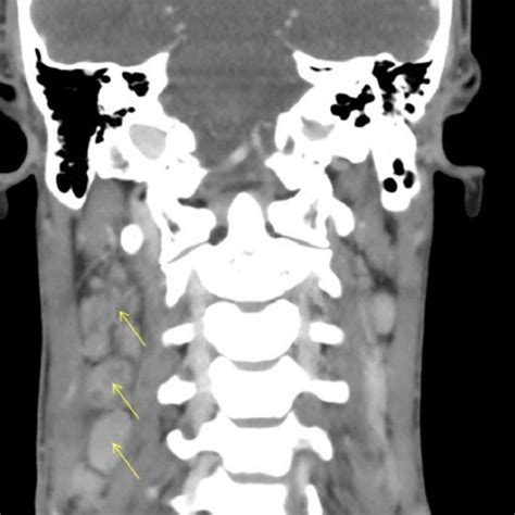 Neck Ct Sagittal Section Of Right Deep Cervical Lymphadenopathy With