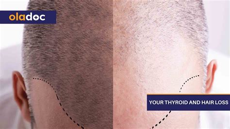 Your Thyroid And Hair Loss Thyroid Care Oladoc