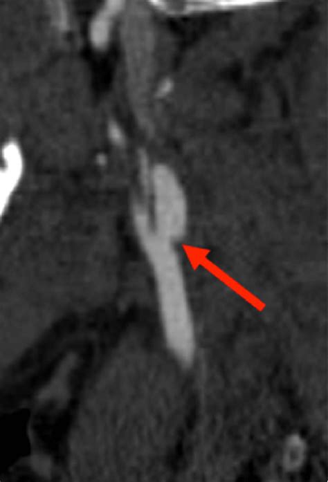 Cervical Arteries Angio Ct Scan On Sagittal View Of Patient 6 Showing A Download Scientific