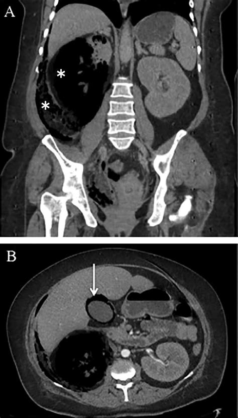 A Coronal View Of Contrast Enhanced Computed Tomography Ct Scan