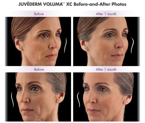 Juvederm Cheeks Before And After Photos