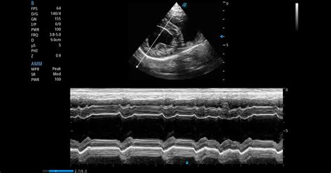 Anatomical M Mode Ultrasound Scanner Training