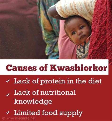 Kwashiorkor Protein Malnutrition Causes Symptoms Diagnosis