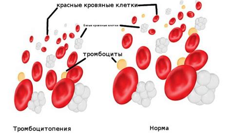Тромбоцитопения: симптомы, причины возникновения, лечение