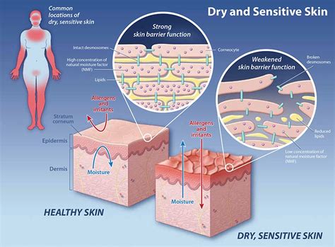 Xerosis and Ichthyosis: A Brief Review | HealthPlexus.net