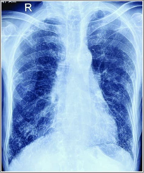 Chest X Ray Posteroanterior View Showing Inhomogeneous Parenchymal