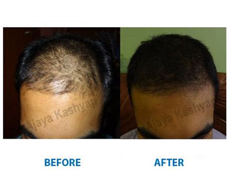 Top 128 Leading Hair Transplant Surgeons In India