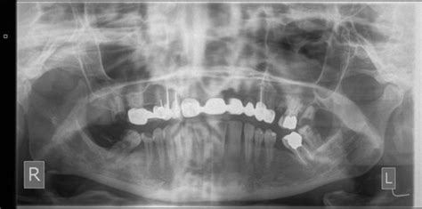 Panoramic Imaging Flashcards Quizlet