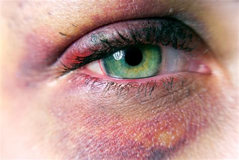 How To Treat A Black Eye Bruise Healthfully