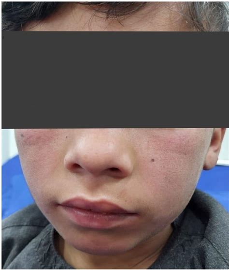 Figure From Muscular Weakness With Calcinosis Cutis A Case Of