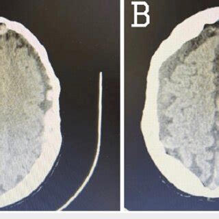 Axial Cut Of Non Contrast Enhanced Brain CT Axial Cut Of Non Contrast