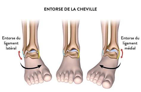 Définition symptômes et diagnostic de l entorse de cheville Dr Paillard