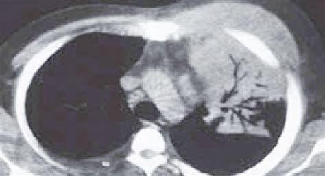 Actinomycosis involving the bone, soft tissues and lung parenchyma ...