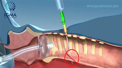 Cómo se realiza una traqueostomía percutánea YouTube