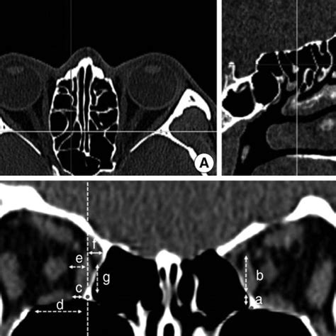 Multiplanar Reconstruction Of The Computed Tomography Scan And Download Scientific Diagram