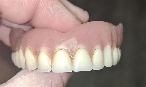 Smile Gallery | Replacing a canine tooth on a denture