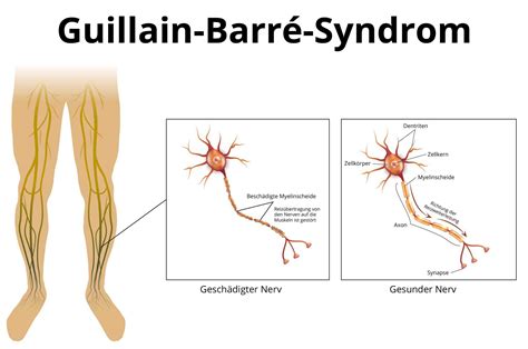 Guillain Barr Syndrom Ursachen Symptome Behandlung