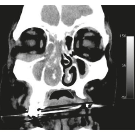 Ct Demonstrates Lesion Occupying Ethmoid Cells Nasal Cavity And