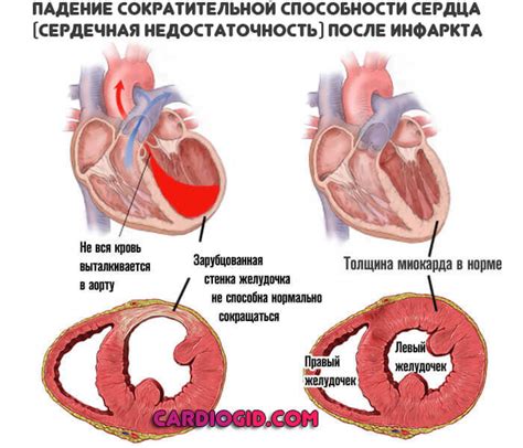 Признаки инфаркта у женщины симптомы и первая помощь в домашних условиях