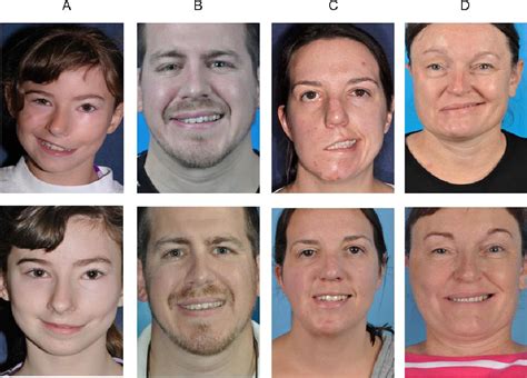 Facial Rehabilitation Operative Techniques In Otolaryngology Head And