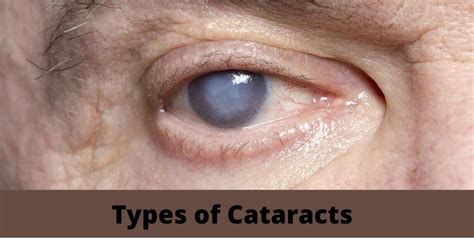 Different Types of Cataracts: Signs, Causes & Ways To Prevent!