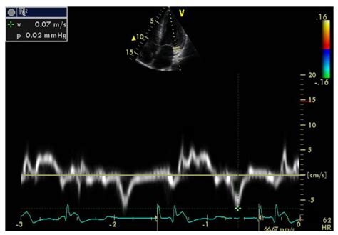 Tissue Doppler Tissue Velocity Imaging The Cardiovascular