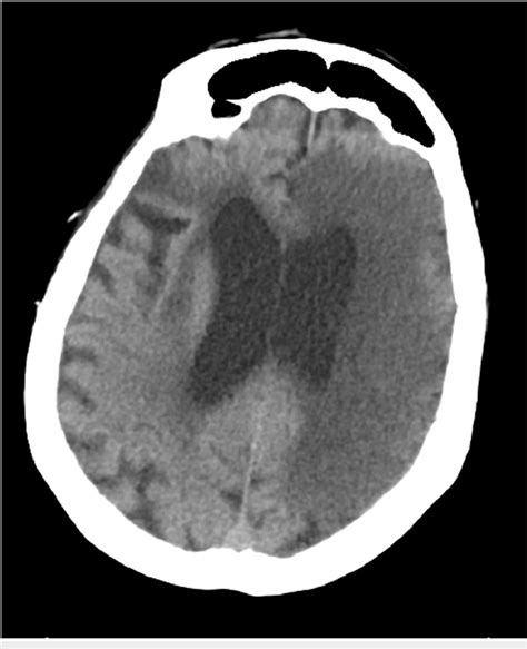 Computed Tomography CT Scan Demonstrating A Large Hypodense Area On