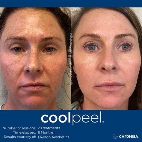 CoolPeel CO2 Laser Resurfacing Treatment In Jacksonville Florida