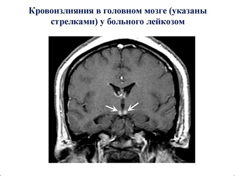 Лейкоз . Определение понятия. Значимость лейкозов - презентация онлайн