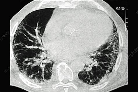 Asbestosis Ct Scan Stock Image C0448789 Science Photo Library