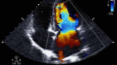 Echocardiogram Of Heart Failure