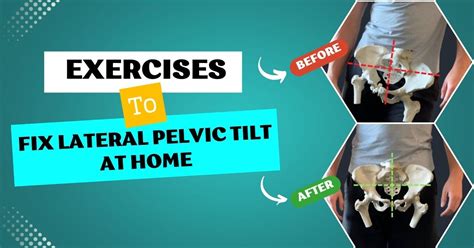 4 Diy Exercises To Fix Lateral Pelvic Tilt At Home Esap