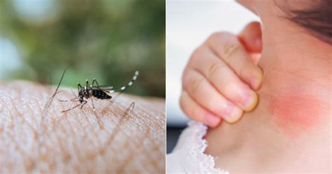 Why Do Mosquito Bites Itch Here Is The Science Behind It