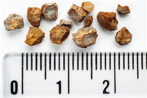 Kidney stones 6-7mm should take medicine or should surgery? | Vinmec