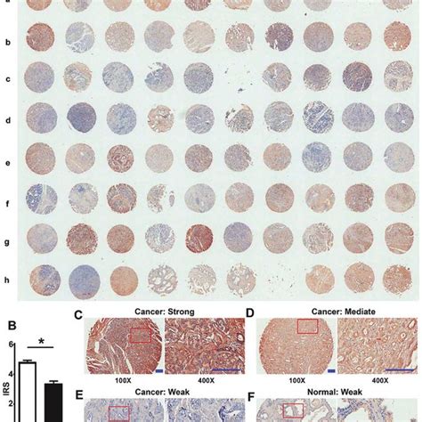 Immunohistochemical Staining Of DEPDC1B In Tumor And Normal Prostate