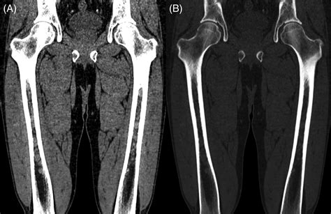 Multiple Myeloma X Ray