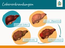 Leberzirrhose Ihre Apotheke Informiert Ber Krankheiten