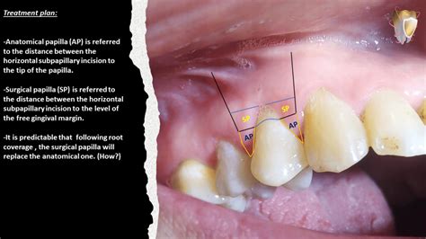 Management Of Single Miller Class I Gingival Recession Through